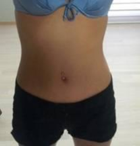 腰腹部吸脂，小肚楠沒(méi)有了