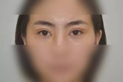 武漢雙眼皮案例分享