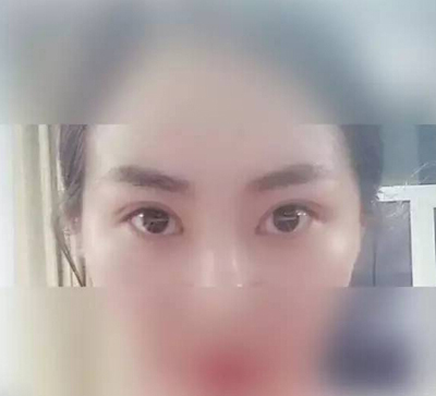 武漢雙眼皮案例分享