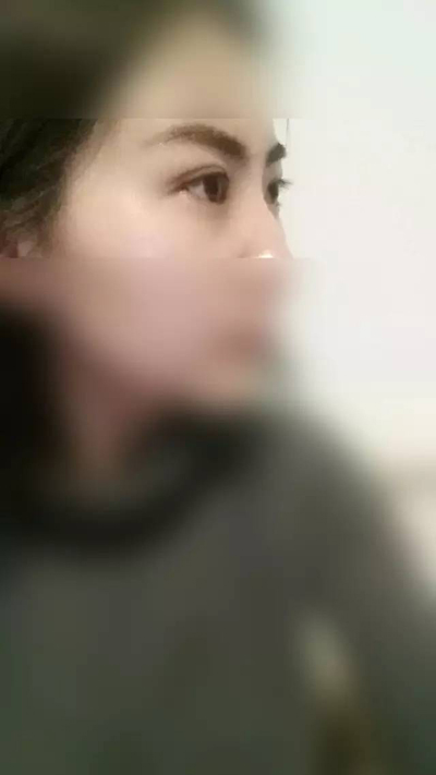 武漢雙眼皮案例分享