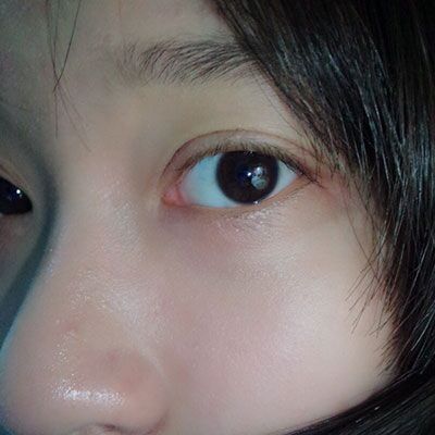 武漢雙眼皮整形案例