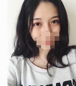 雙眼皮