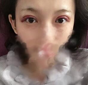 雙眼皮