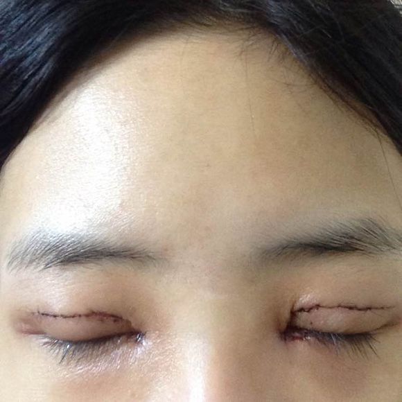 武漢雙眼皮整形案例
