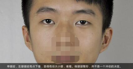 埋線雙眼皮