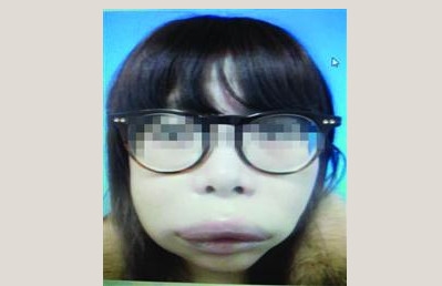 女子朋友圈約人上門打玻尿酸：6針后恐怖變化