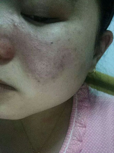 激光去紅血絲，便宜又好