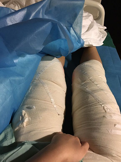 大腿吸脂后，讓我覺得我真的是人氣簡直爆表了