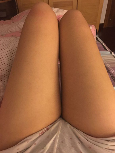 大腿吸脂后，讓我覺得我真的是人氣簡直爆表了