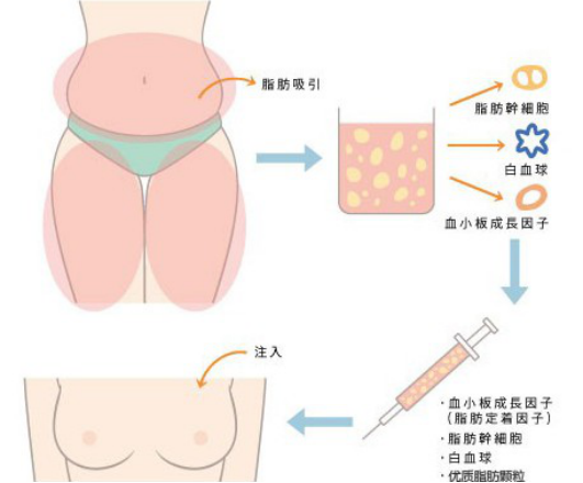 自體脂肪隆胸