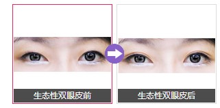 生態(tài)性雙眼皮手術(shù)后，看上去特別精神
