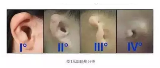 小耳畸形的嚴(yán)重程度