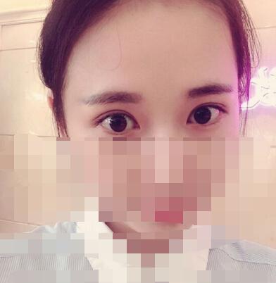 雙眼皮手術(shù) 讓我擁有了夢寐以求的雙眼皮
