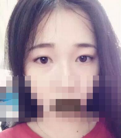 雙眼皮手術(shù) 讓我擁有了夢寐以求的雙眼皮
