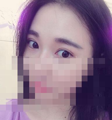 雙眼皮手術(shù) 讓我擁有了夢寐以求的雙眼皮