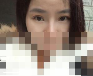 全切雙眼皮案例