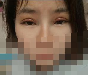 全切雙眼皮