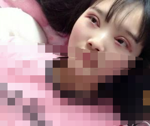 雙眼皮+開眼角