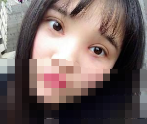 雙眼皮+開眼角