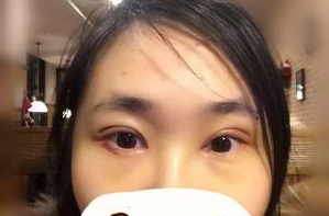 雙眼皮術(shù)后第5天