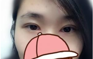 雙眼皮術(shù)后17天