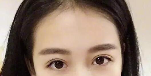 雙眼皮術(shù)后
