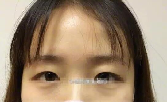 雙眼皮術(shù)前