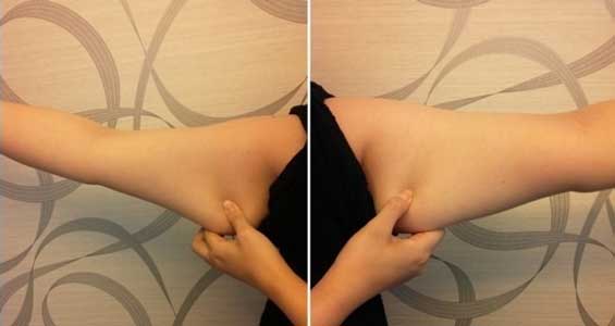 手臂吸脂，讓我徹底告別蝙蝠袖