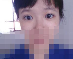 雙眼皮術后47天