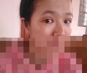 雙眼皮