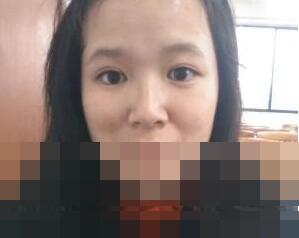 雙眼皮術后20天