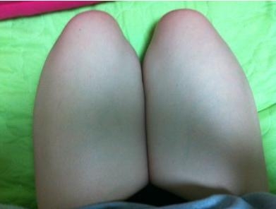 大腿吸脂，讓我擺脫了大象腿