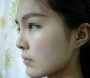 隆鼻