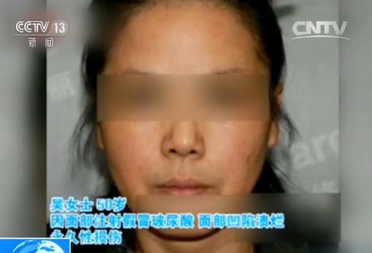 “?！闭菔鹿暑l頻發(fā)生 22歲女孩注射“玻尿酸”失明