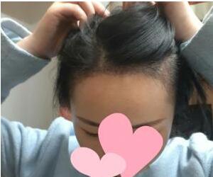 發(fā)際線種植
