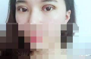 雙眼皮術后