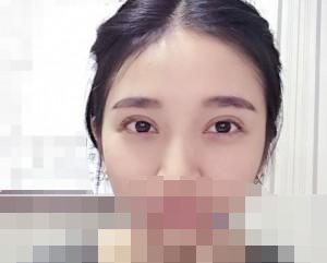 開內(nèi)眼角案例