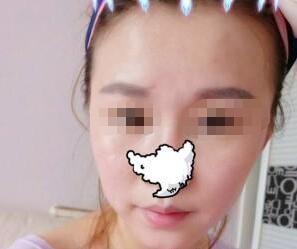 激光祛雀斑