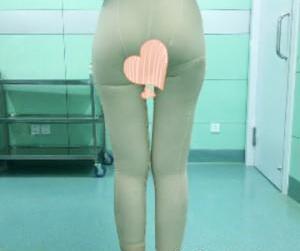 大腿吸脂術(shù)后