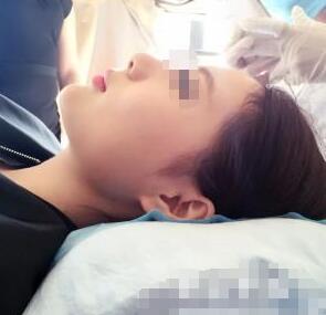 假體隆鼻