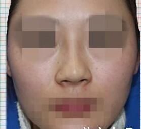隆鼻假體取出