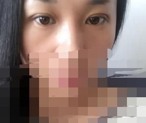 埋線雙眼皮