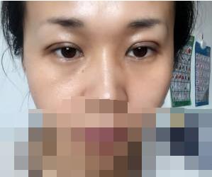 埋線雙眼皮第三天