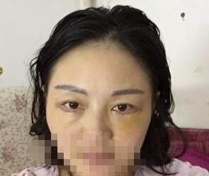 祛眼袋效果