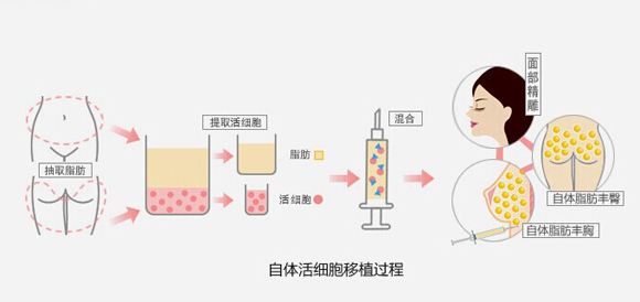 自體脂肪填充面部