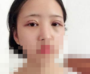 雙眼皮術(shù)后拆線(xiàn)