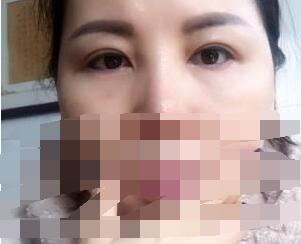 手術(shù)效果
