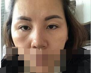 埋線雙眼皮修復(fù)之前