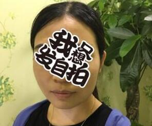 隆下巴