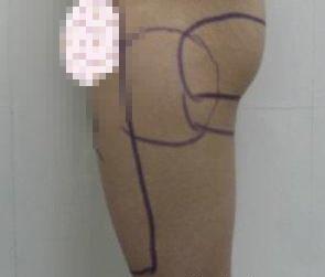 大腿吸脂